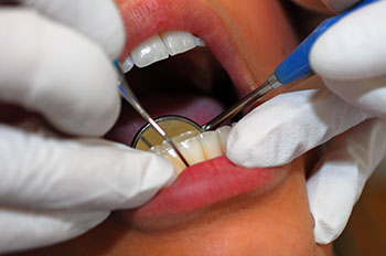 Dentalhygiene mit Deep Scaling
