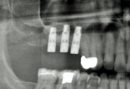 Implantate - Dr Czernicky Wien